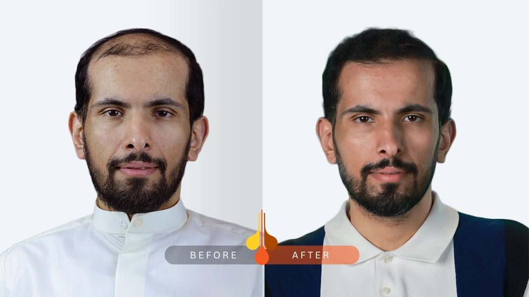 hair-transplant-4
