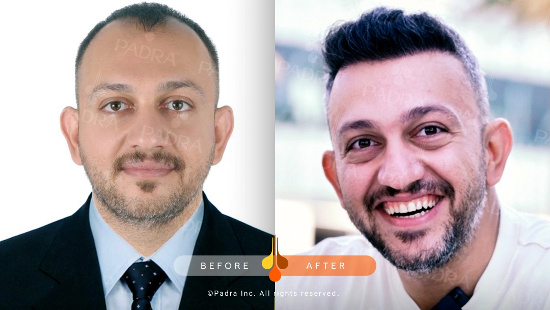hair transplant in qatar (6)
