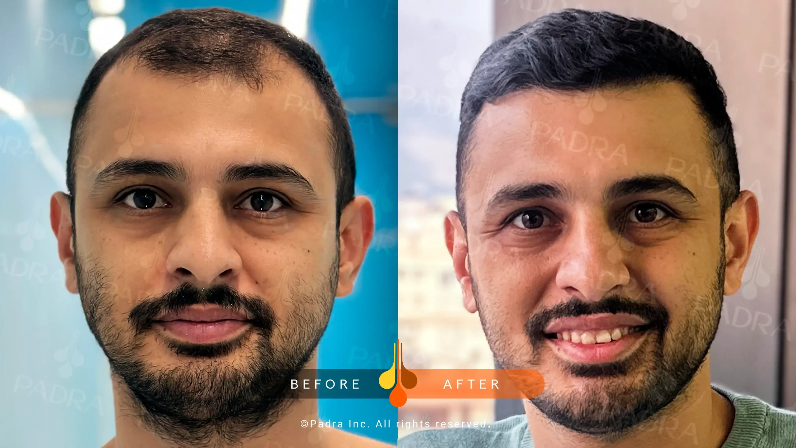 hair transplant in qatar (7)