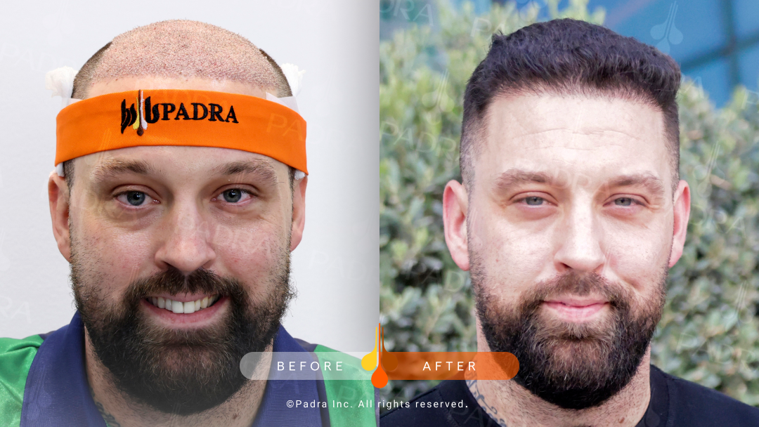 Fresh hair transplant results in Kuwait
