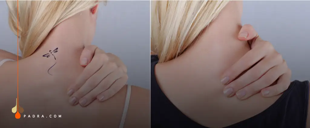 Choosing the Right Clinic for Tattoo Removal
