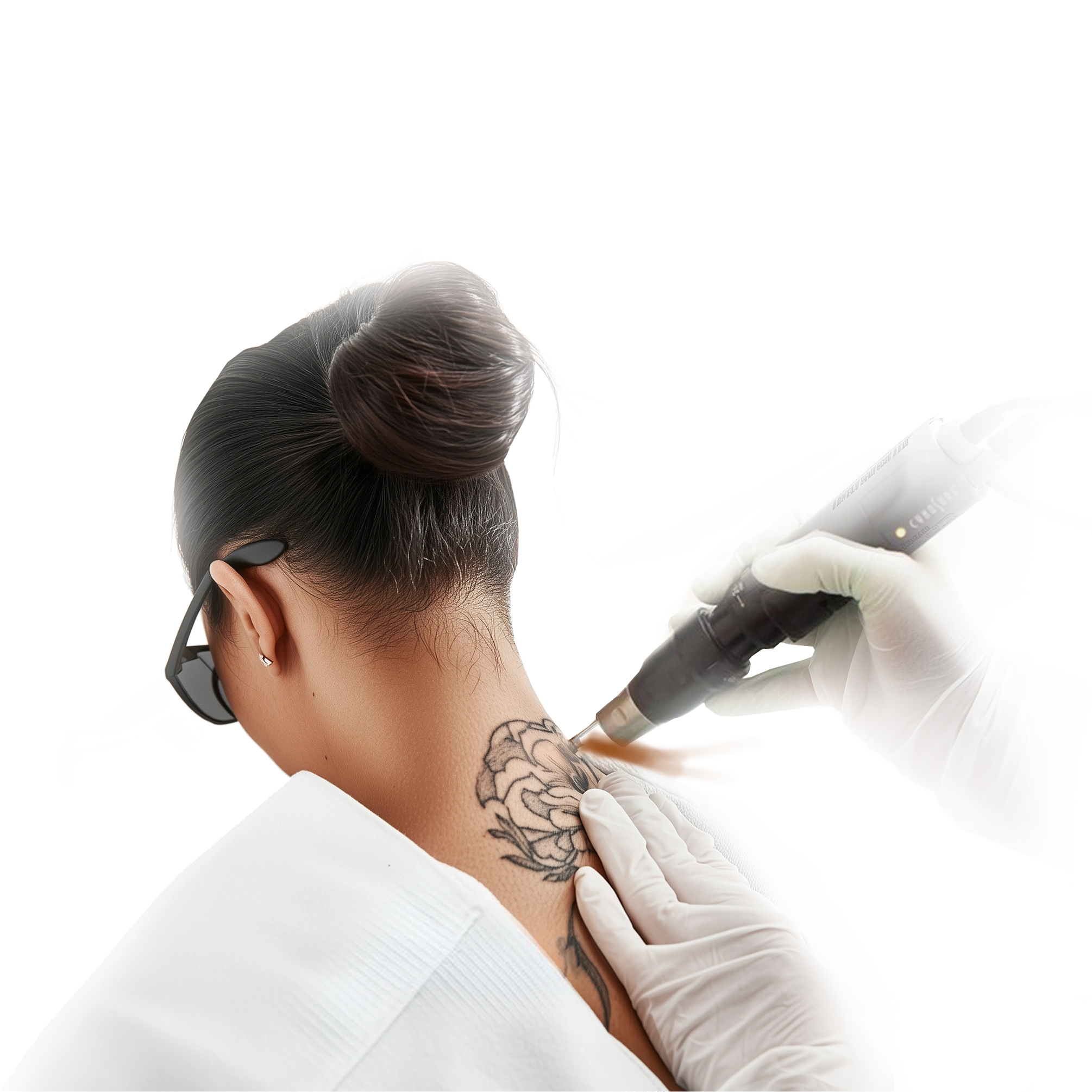 Laser tattoo removal
