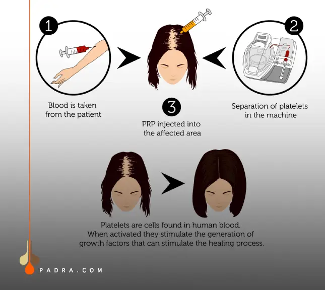PRP Hair Treatment Process