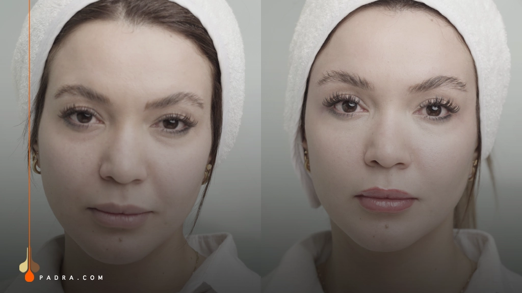 temple filler injection before and after