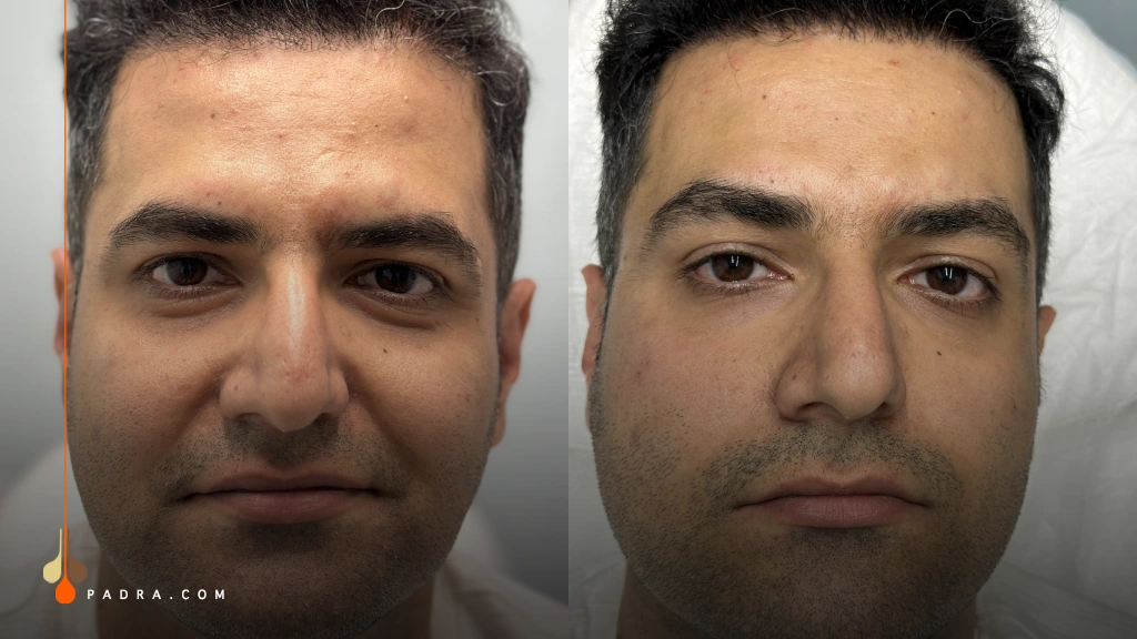tear trough filler before and after