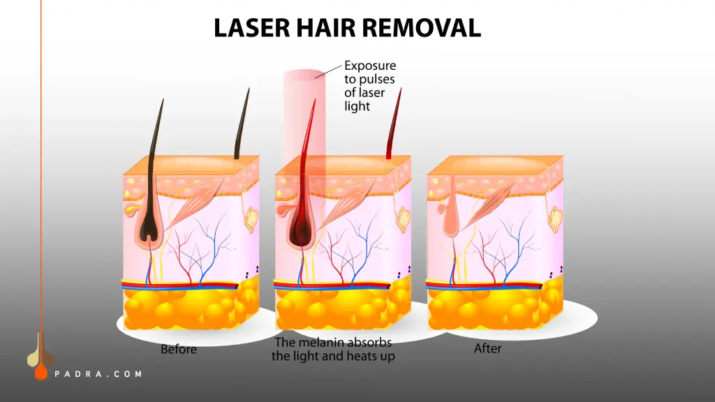 How does Laser Hair Removal work؟