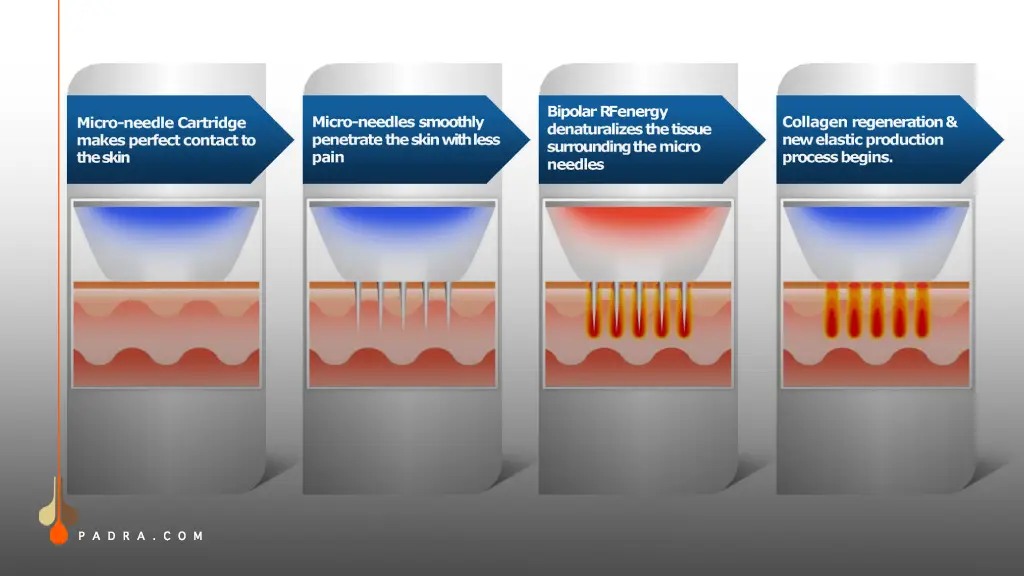 how does RF Microneedling working?