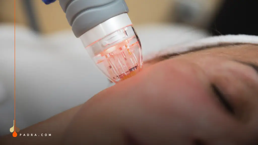 RF Microneedling in Padra Clinic
