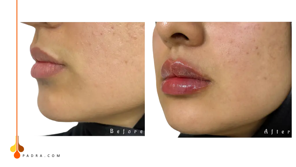 lip filler before and after