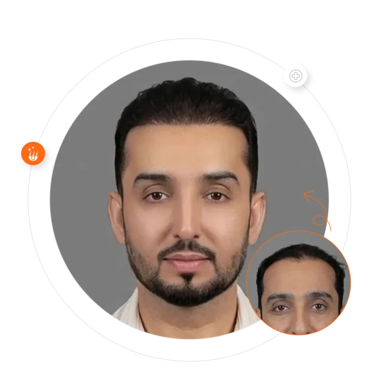 hair transplant results in Dubai at Padra Clinic - زراعة الشعر في دبي في عيادة بادرا