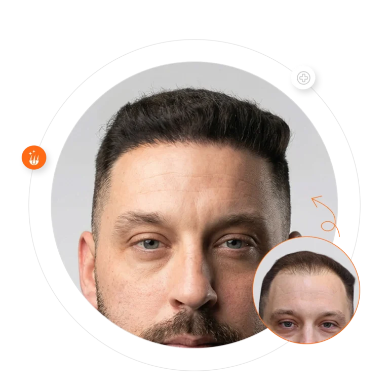 Hair transplant at Padra Clinic Doha