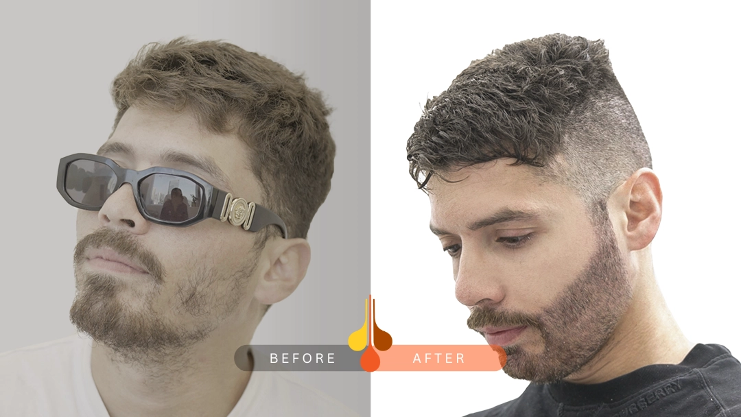 قبل وبعد زراعة شعر اللحية لملء الفراغات