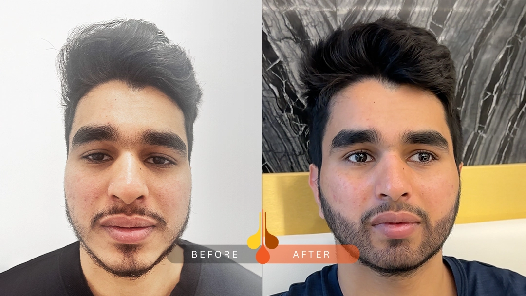 hair transplant before and after results in Padra: sample 7