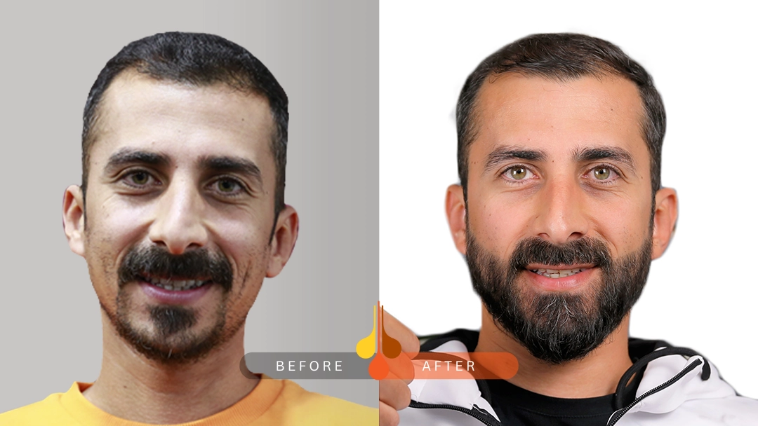 قبل وبعد زراعة اللحية للحصول على كثافة طبيعية