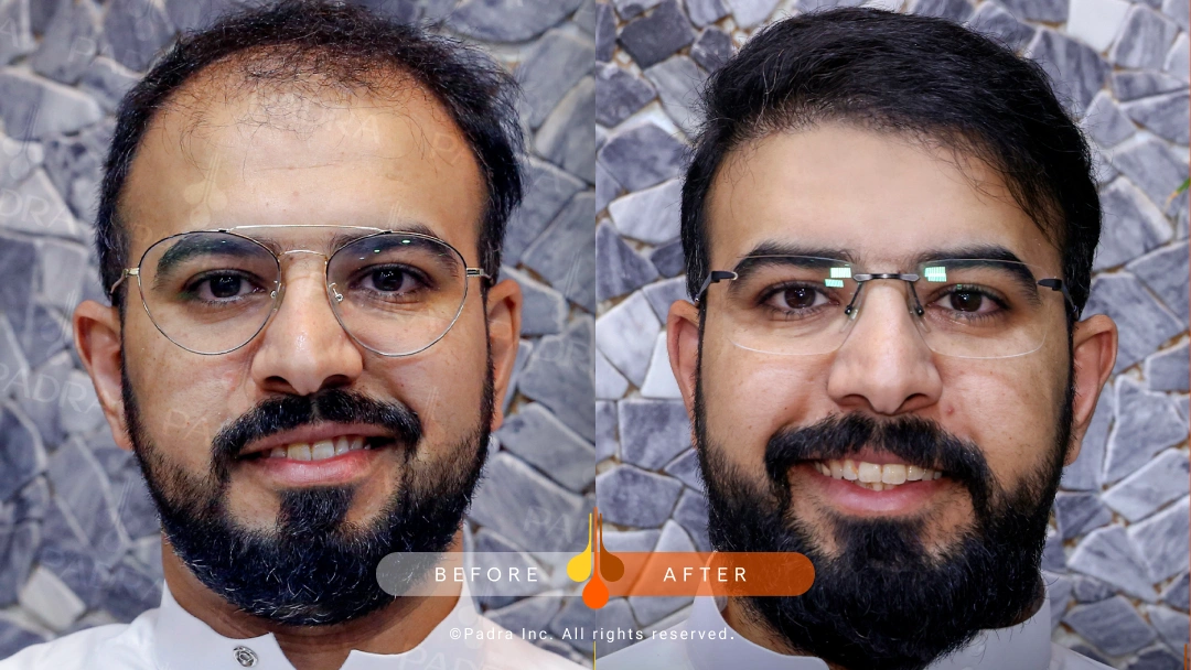 hair transplant in qatar