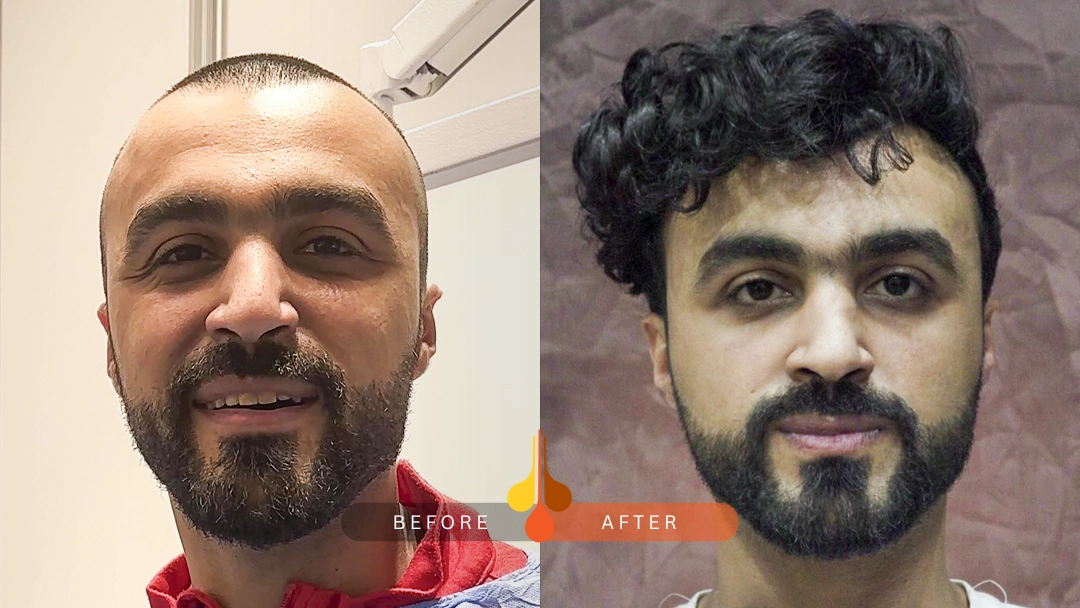 صور قبل و بعد زراعه الشعر