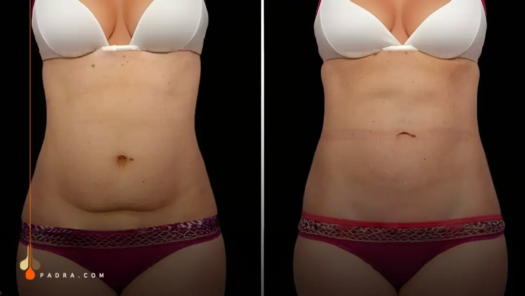 Cryolipolysis before and after