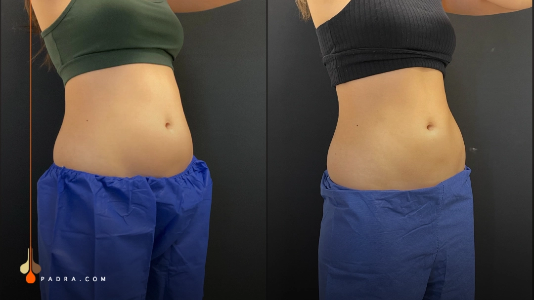 cryolipolysis before and after