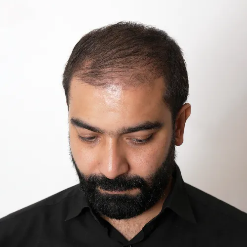 3 Months After Hair Transplant