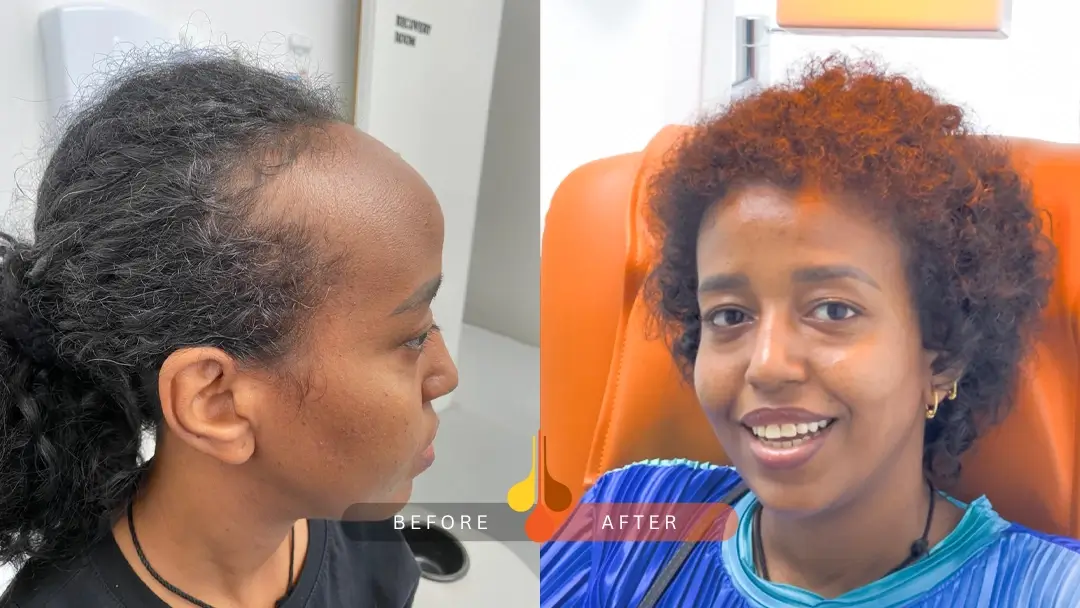 hair transplant for women before and after images