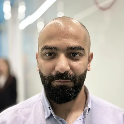 Before Hair Transplant