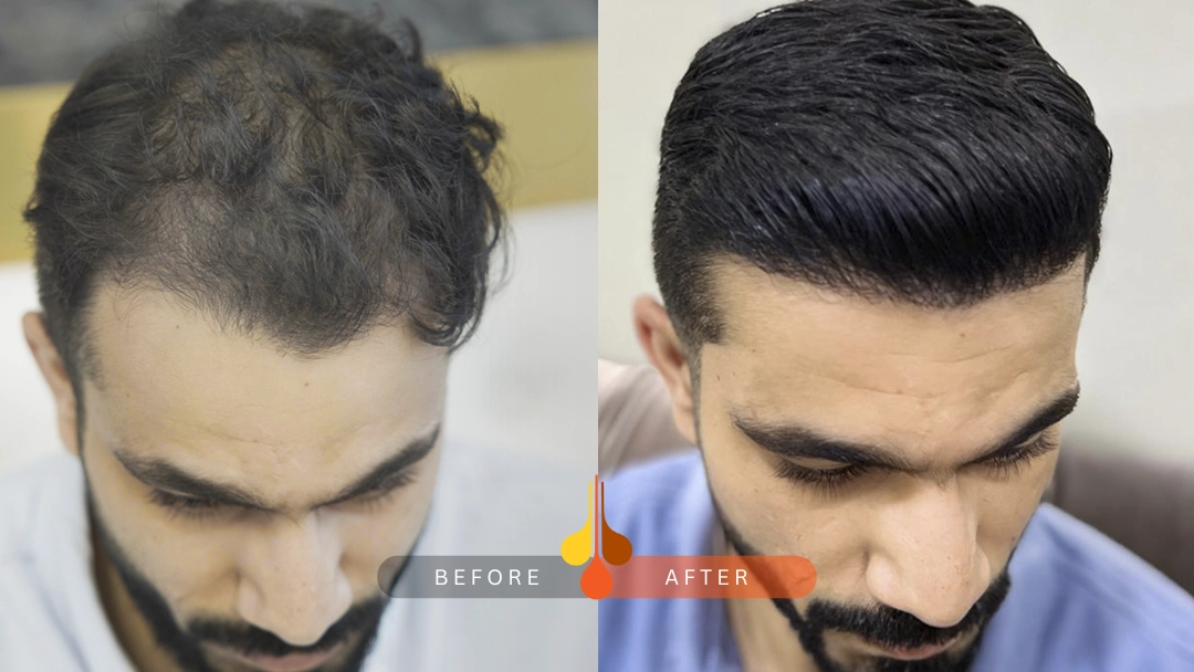 result of hair transplant in qatar