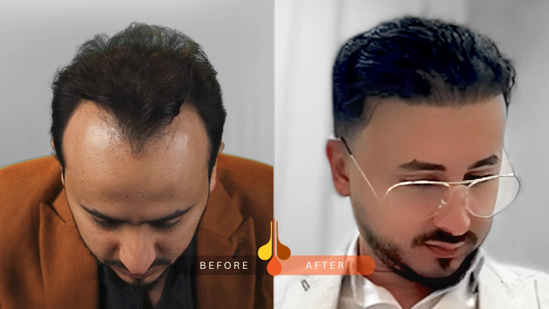 result of hair transplant in qatar2