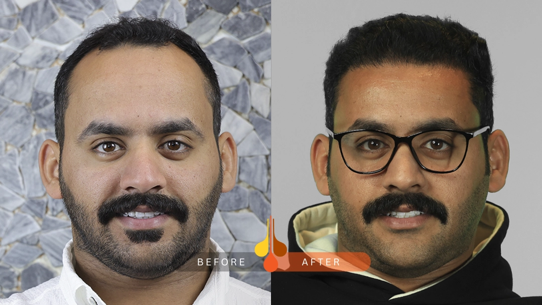 result of hair transplant in qatar3