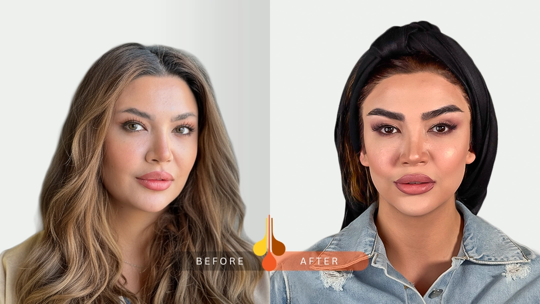 Natural eyebrow transplant results in Kuwait