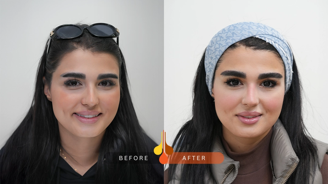 Healthy eyebrow restoration in Kuwait