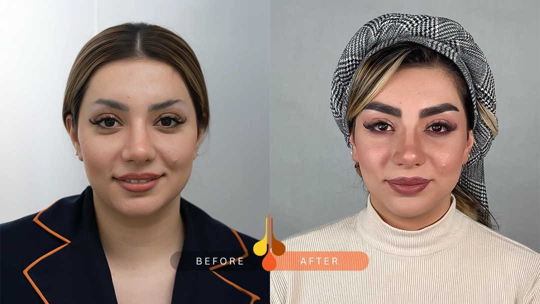 Before and after eyebrow transplant at Padra Clinic Kuwait