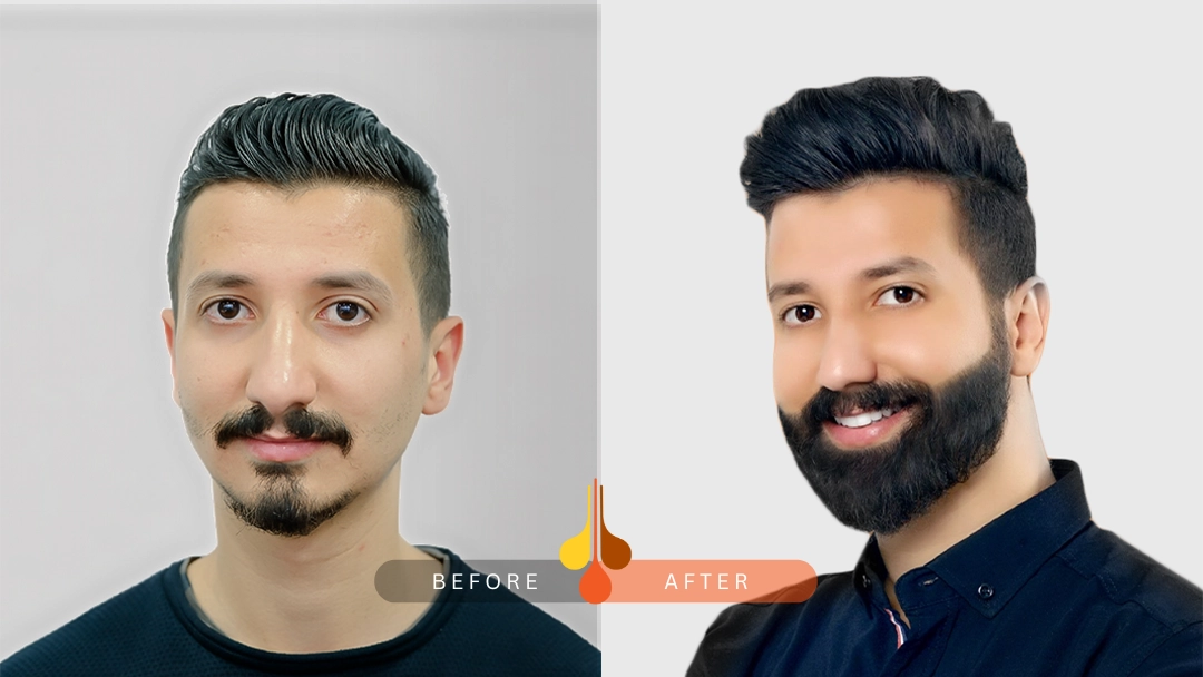 صورة قبل و بعد زراعة اللحية في عيادة بادرا دبي