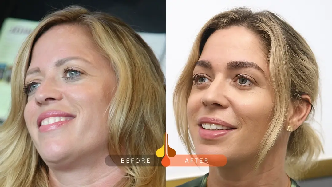 Eyebrow transformation at Padra Clinic Doha