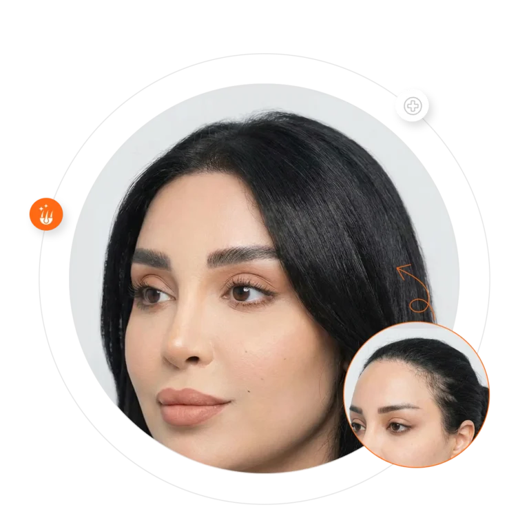 Female hair transplant results at Padra Clinic Doha