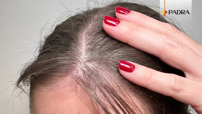 seborrheic-dermatitis