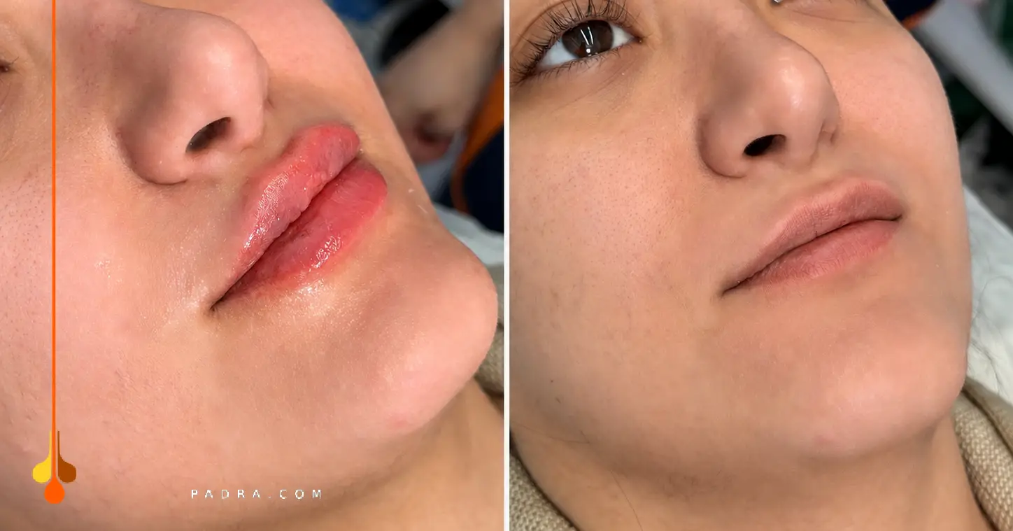 Chin Filler Recovery and Aftercare