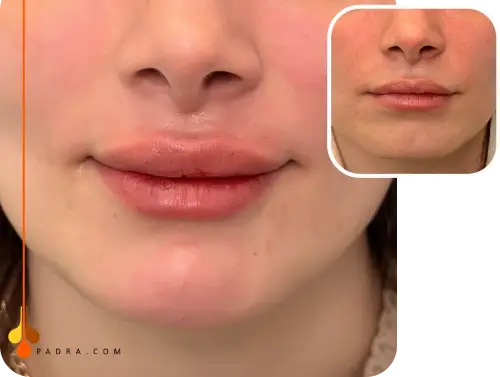 Chin Filler before and after